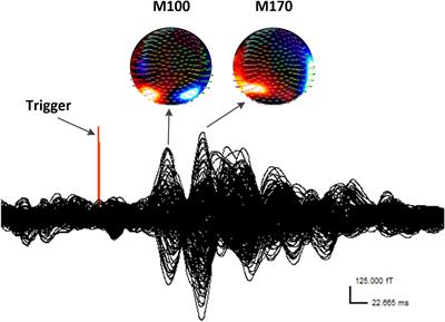 Interictal Abnormalities of Neuromagnetic Gamma Oscillations in Migraine Following Negative Emotional Stimulation